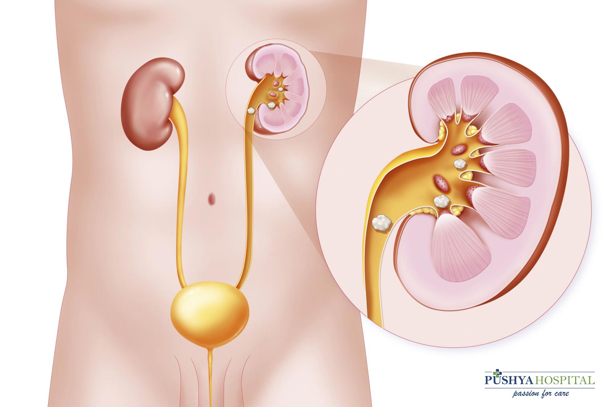 KidneyStoneTreatment